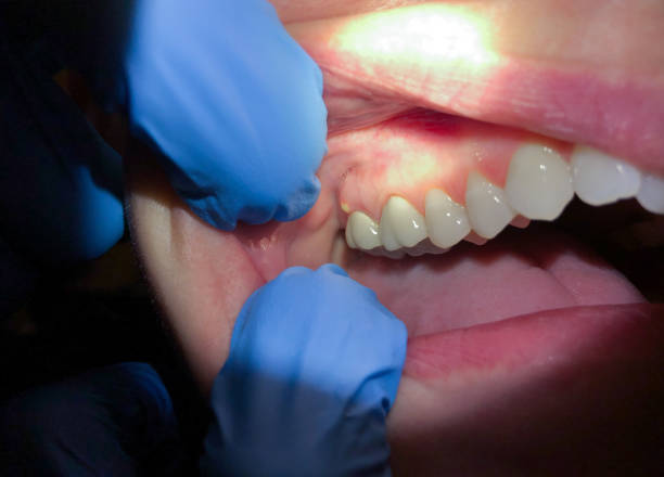 Best Emergency Root Canal Treatment in St Johns, MI